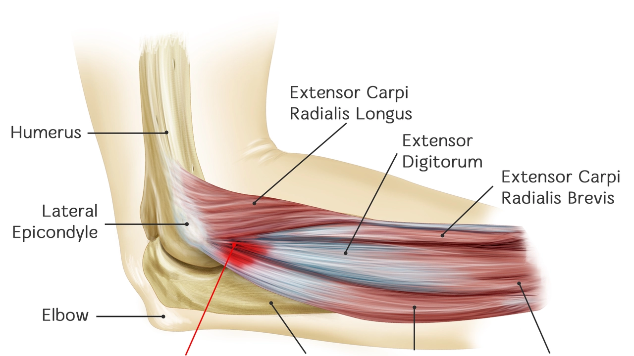 How long can you have tennis elbow before it's irreversible?